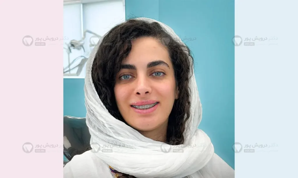 ارتودنسی ثابت شاخص