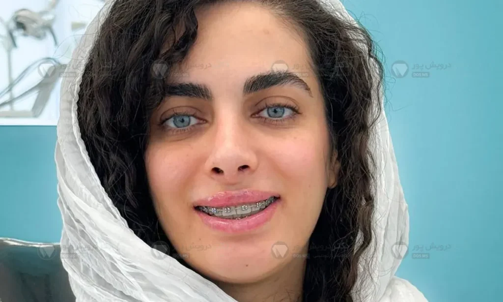 ارتودنسی ثابت دندان