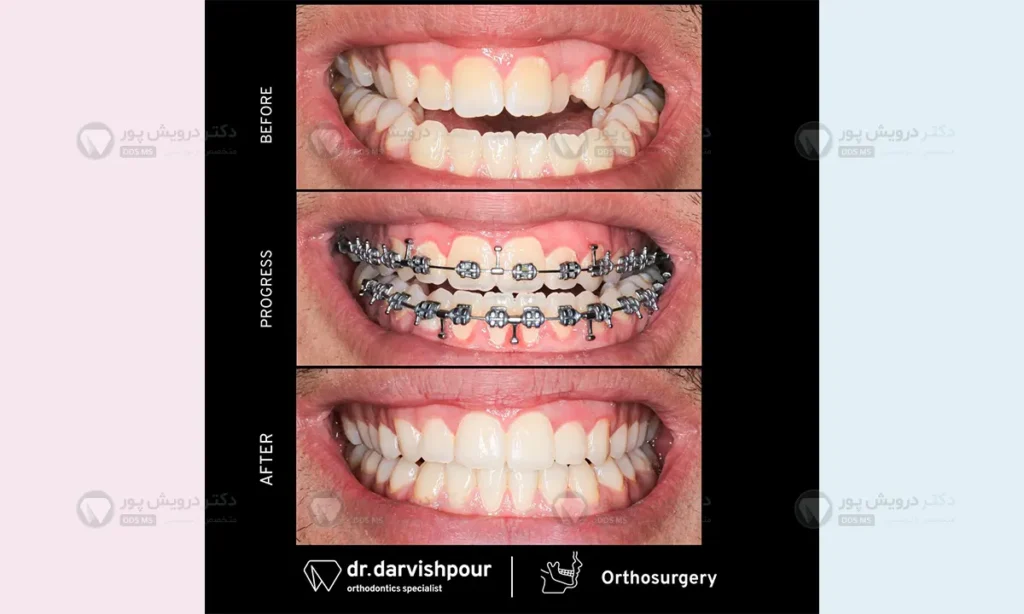 ارتودنسی ثابت