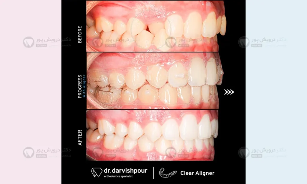 ارتودنسی نامرئی با الاینر شفاف بهترین روش ارتودنسی برای نامرتبی های جزئی تا متوسط
