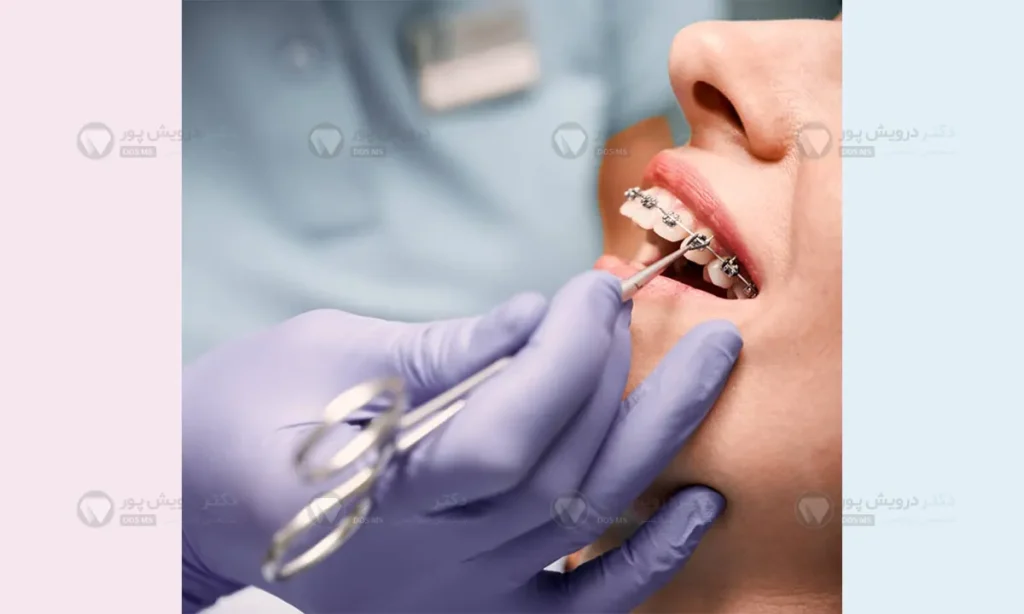سیم کشی دندان