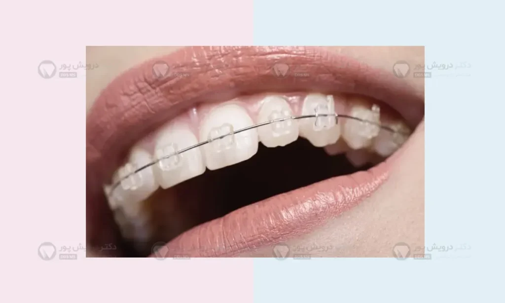 عکس ارتودنسی سرامیکی