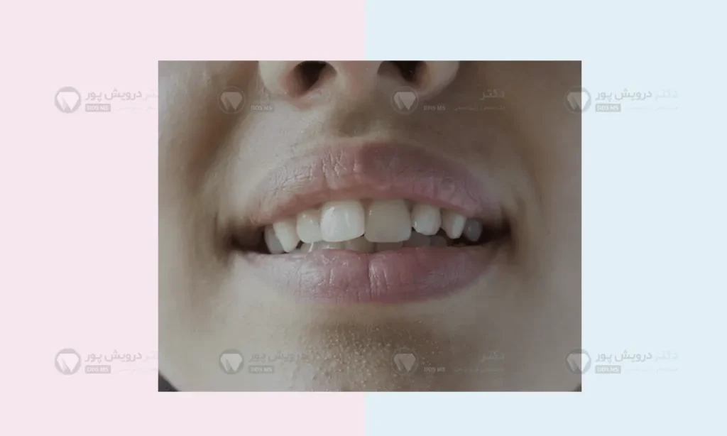 نامرتبی دندان ها