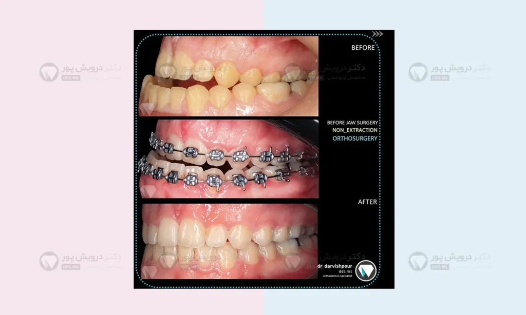 ناهنجاری فکی و نامرتبی دندانی با هم