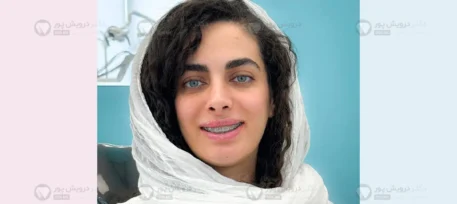 ارتودنسی ثابت شاخص