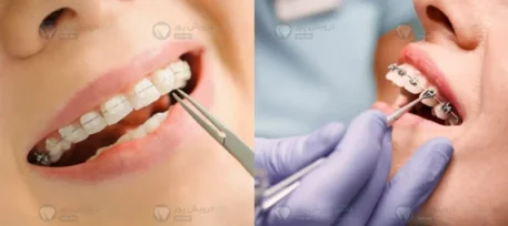 ارتودنسی سرامیکی شاخص