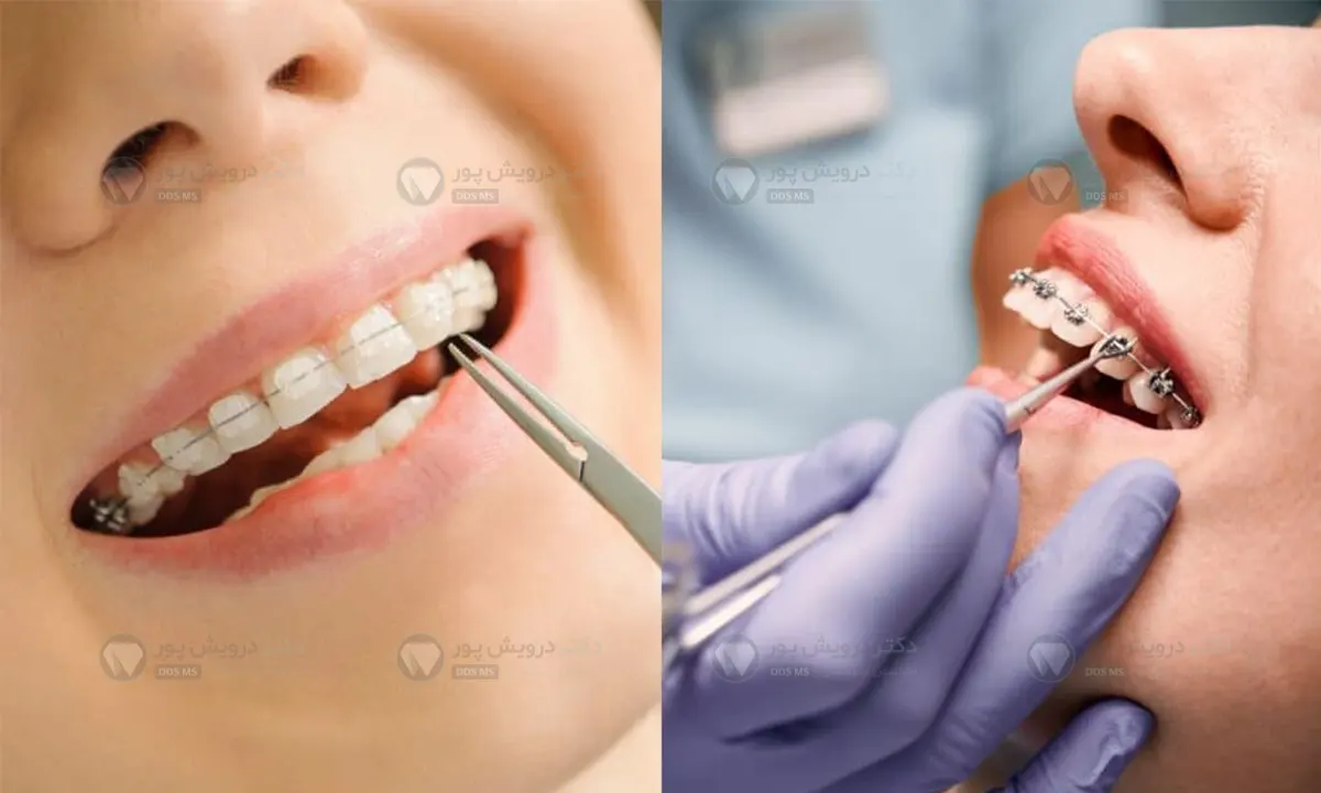 ارتودنسی سرامیکی شاخص