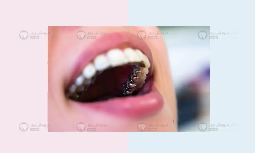 ارتودنسی ثابت لینگوال