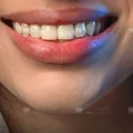 ارتودنسی نامرئی با الاینرهای شفاف