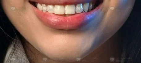 ارتودنسی نامرئی با الاینرهای شفاف
