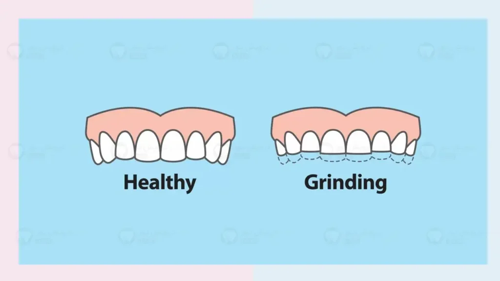 دندان قروچه
