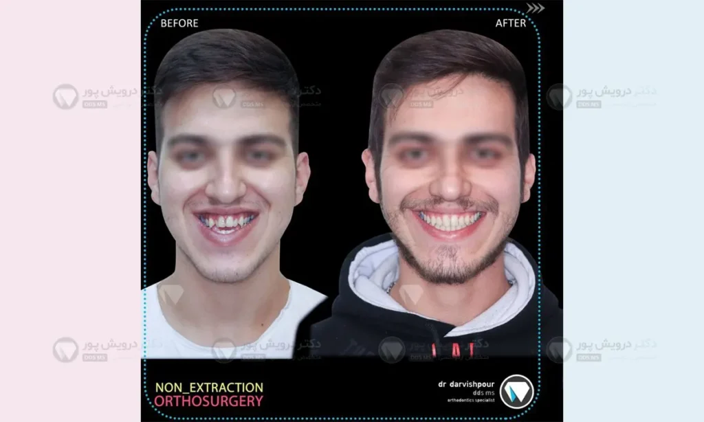 ارتودنسی ثابت نوجوانان