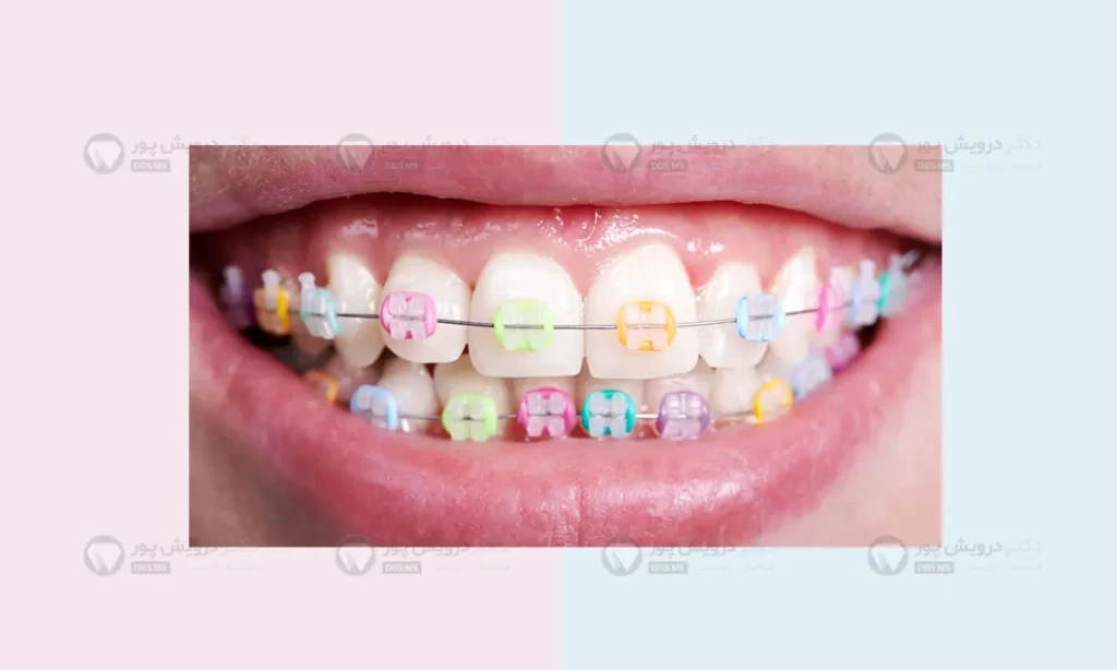 انتخاب ارتودنسی رنگی ترکیبی