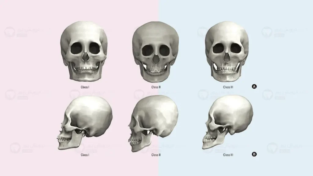 انواع مال اکلوژن شماتیک