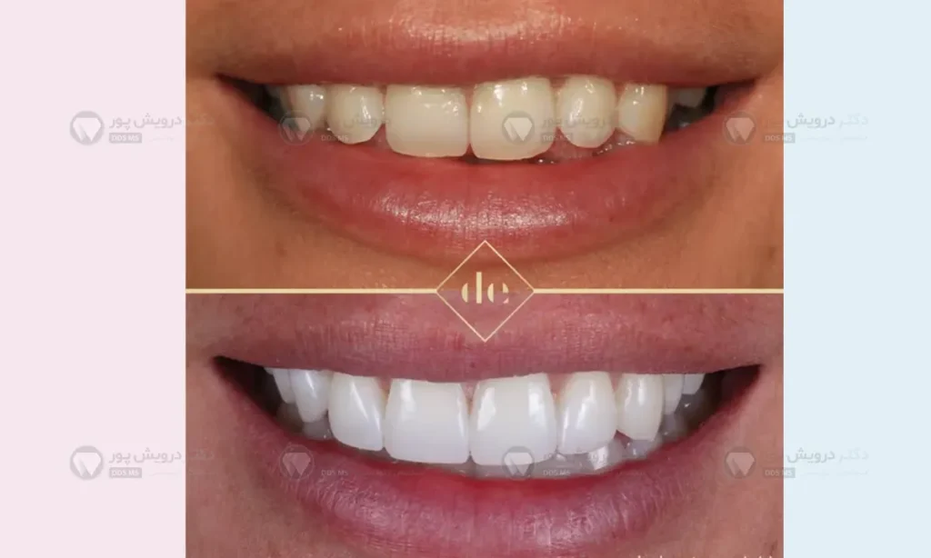 عکس قبل  و بعد از بلیچینگ دندان