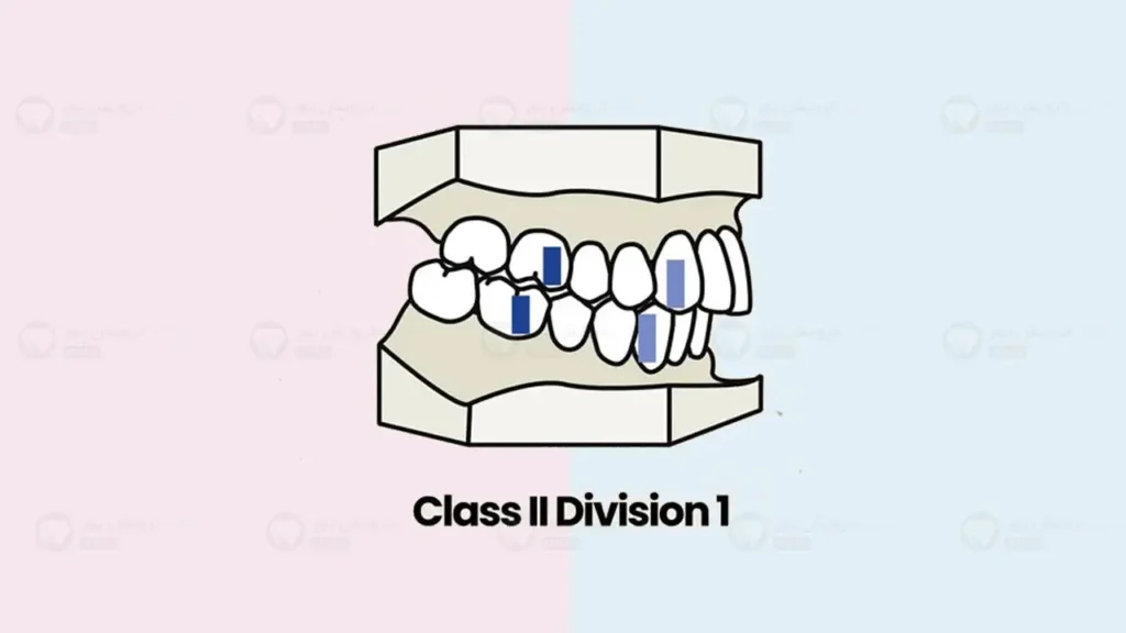 مال اکلوژن کلاس 2 بایت عقب