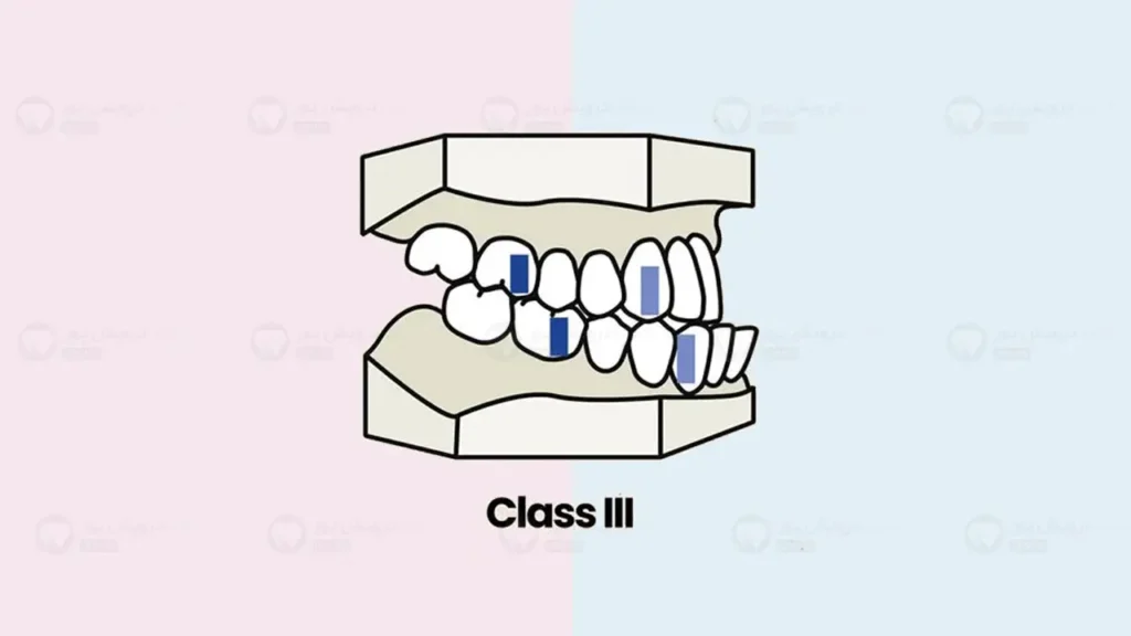 مال اکلوژن کلاس 3