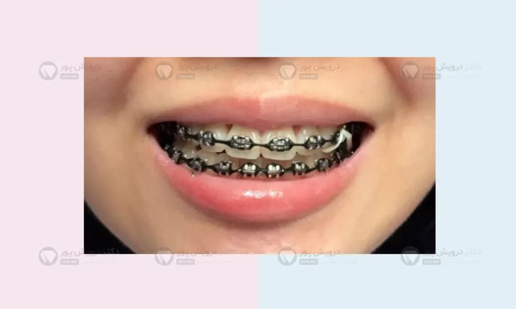 کش ارتودنسی مشکی رنگ