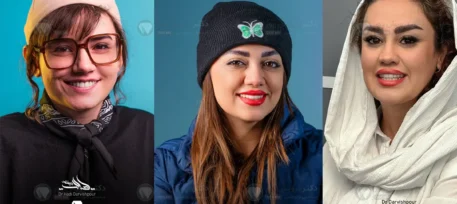 سفید کردن دندان ها بعد از ارتودنسی شاخص