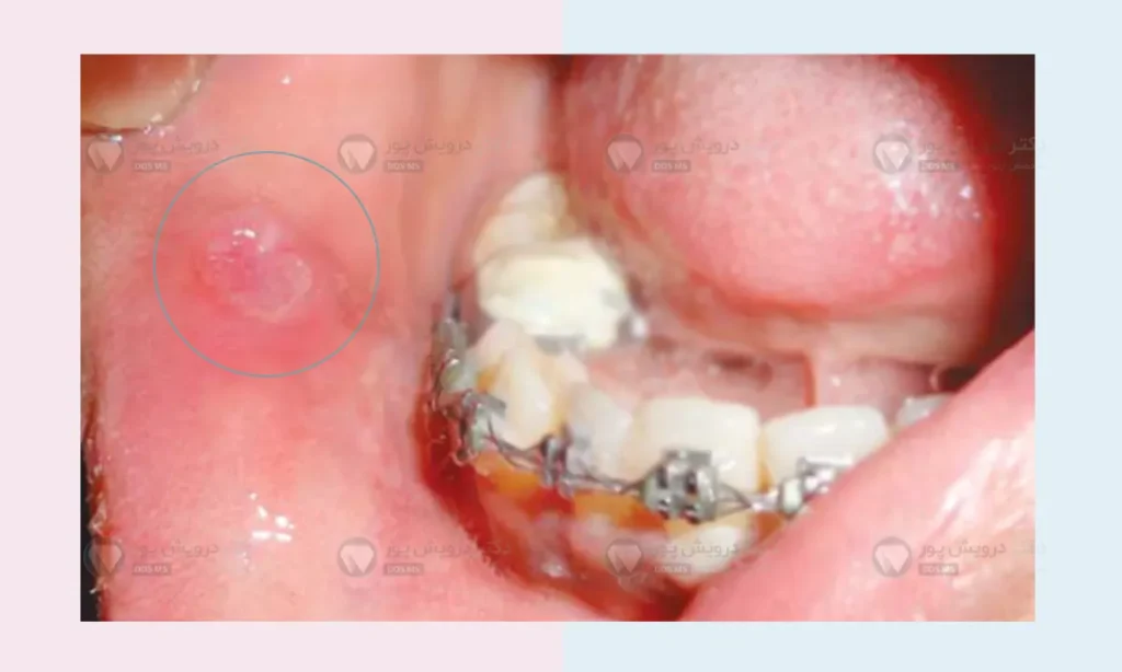 زخم ارتودنسی دندان