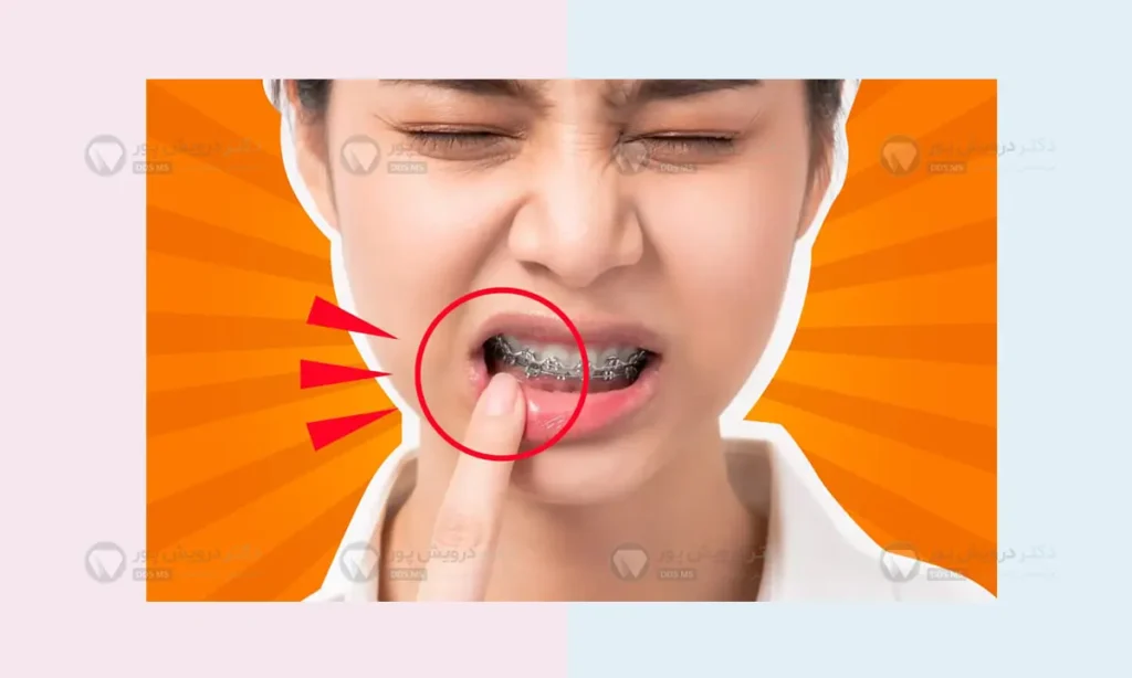 زخم براکت ارتودنسی شاخص