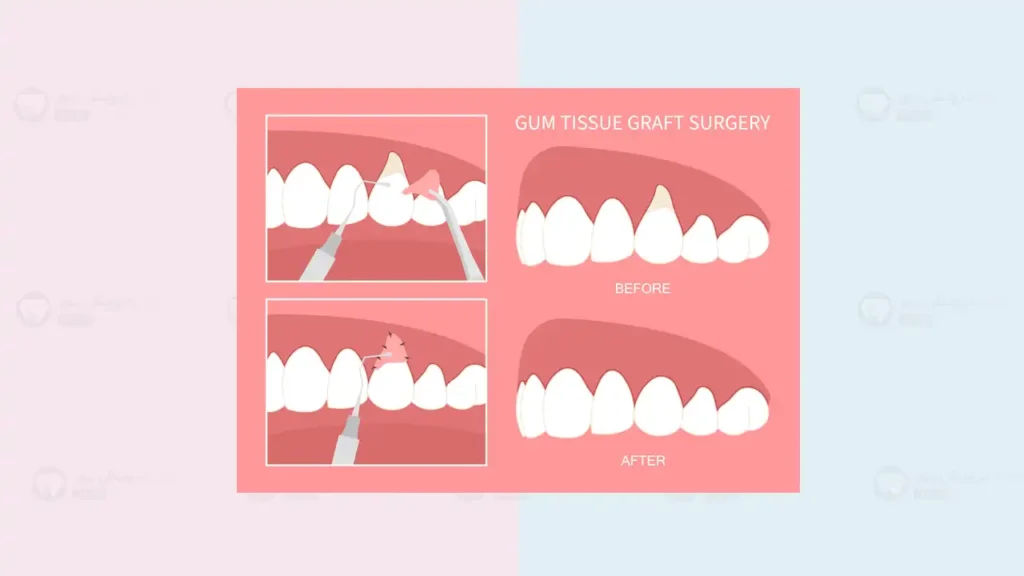 عمل جراحی لثه