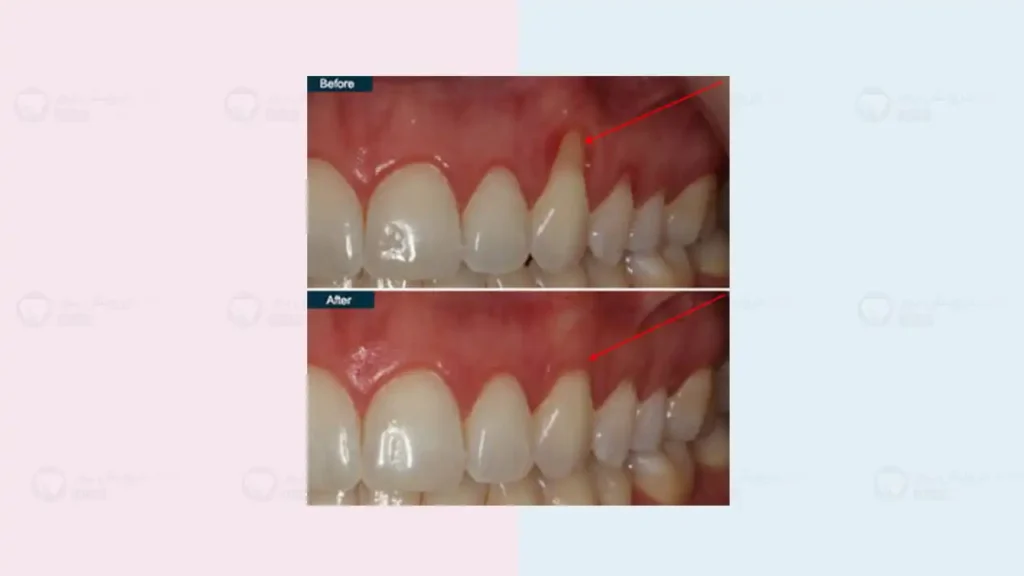 عکس تحلیل لثه