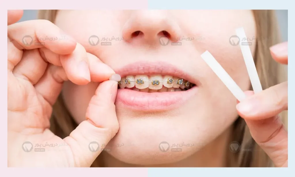 موم ارتودنسی برای درد ارتودنسی