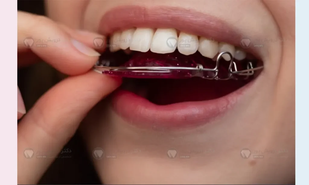 نگهدارنده متحرک ارتودنسی هاولی