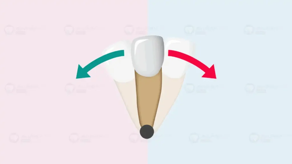 نیورهای ارتودنسی و تحلیل لثه در ارتودنسی