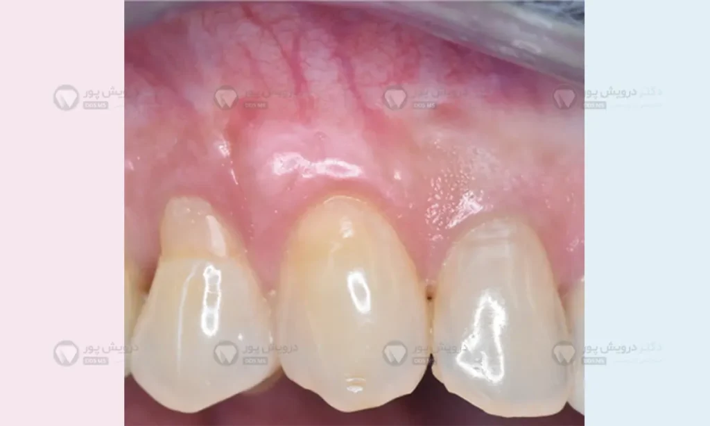 موقعیت نامناسب دنداندر ابتدای درمان