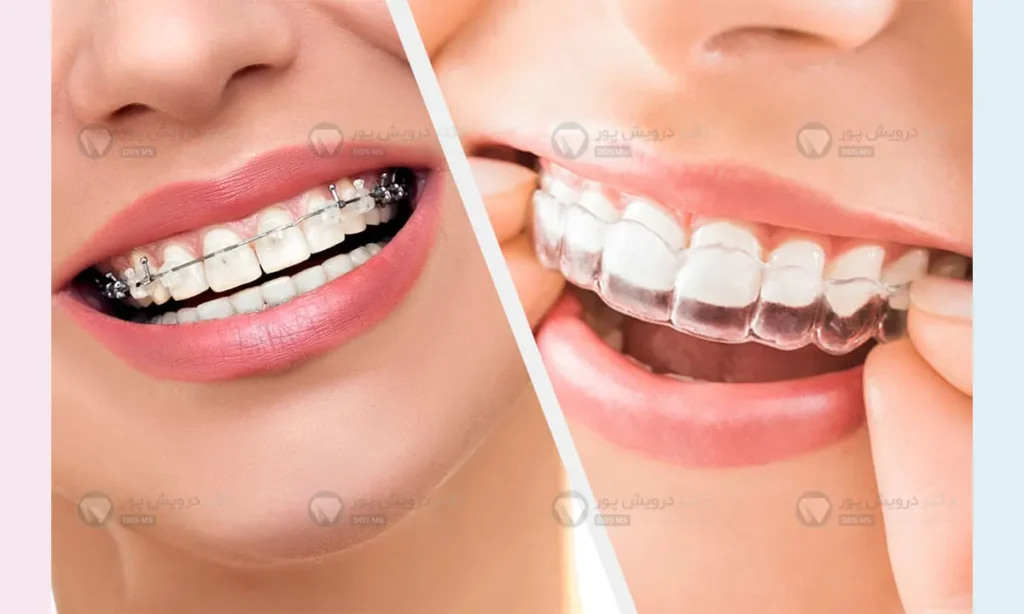 فرق ارتودنسی ثابت و متحرک