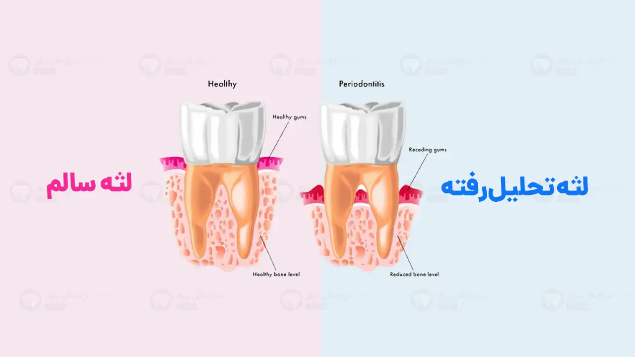 دلایل احتمالی تحلیل لثه در زمان ارتودنسی چیست؟