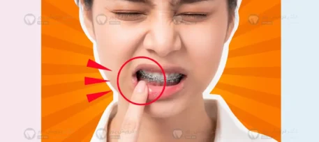 زخم براکت ارتودنسی شاخص