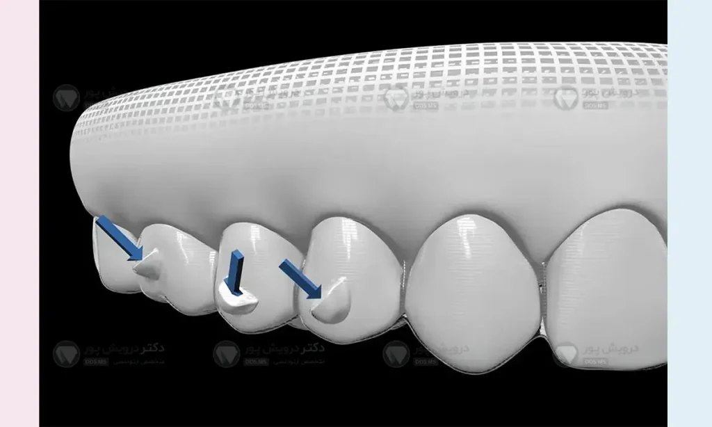 اتچمنت ارتودنسی نامریی