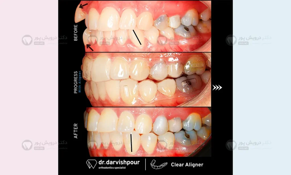 گذاشتن و برداشتن الاینر شفاف
