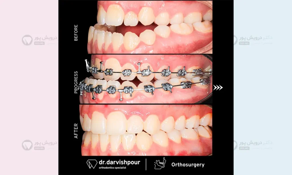 ارتودنسی با جراحی فک پایین
