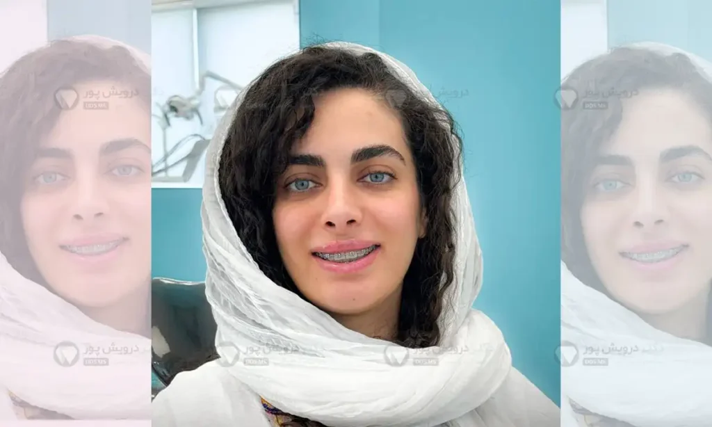 ارتودنسی دیمون شفاف