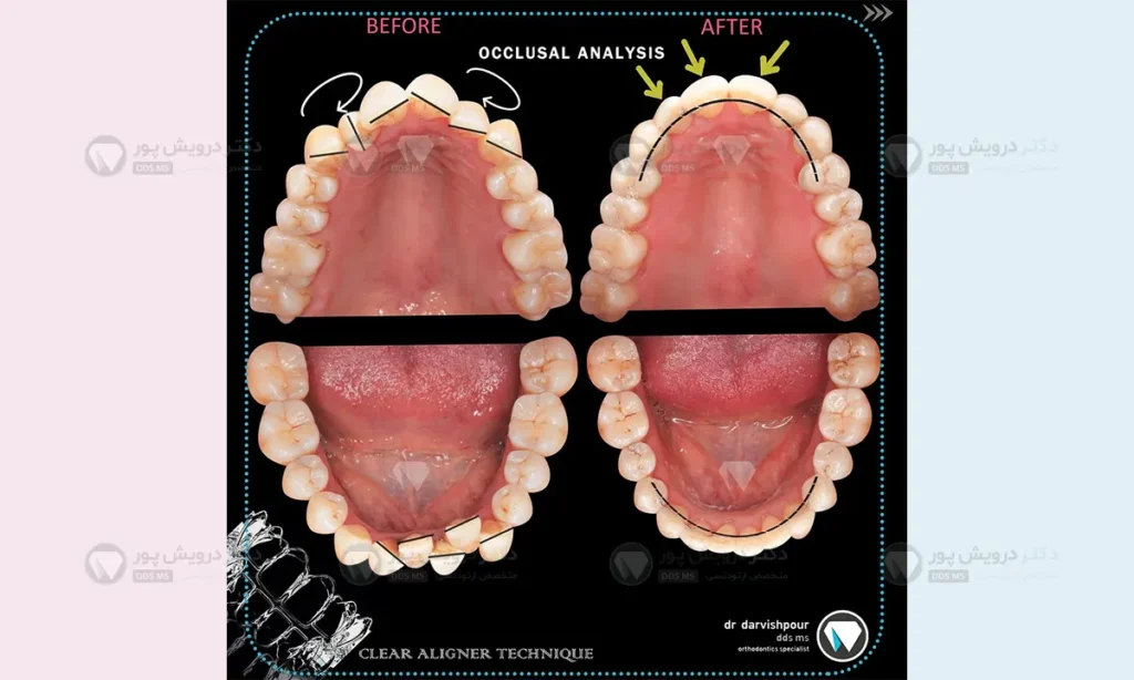 ارتودنسی دندان شلوغ