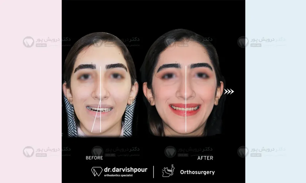 ارتودنسی فقط یک فک