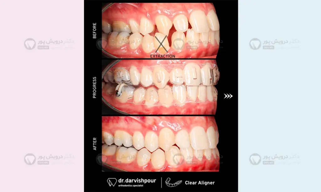 قبل و بعد از بستن فاصله بین دندان ها با ارتودنسی