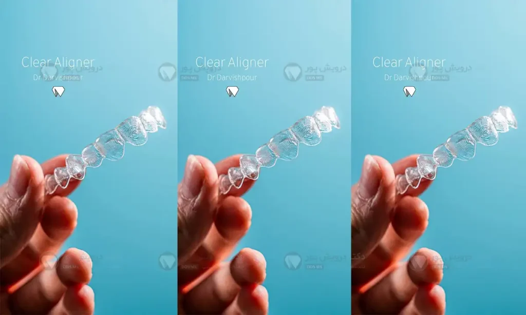 استفاده از الاینرهای شفاف برای بلیچینگ دندان