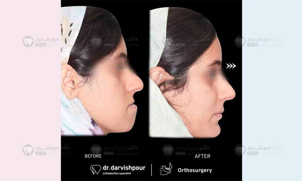 بسته نشدن لب