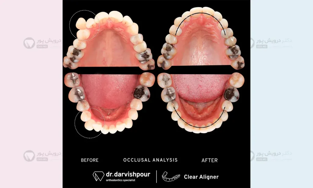 درمان تنگی فک بالا در بزرگسالان
