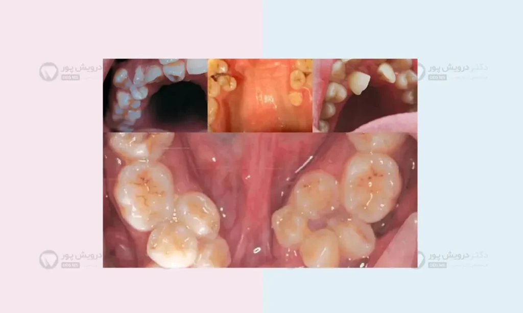 عکس دندان اضافی