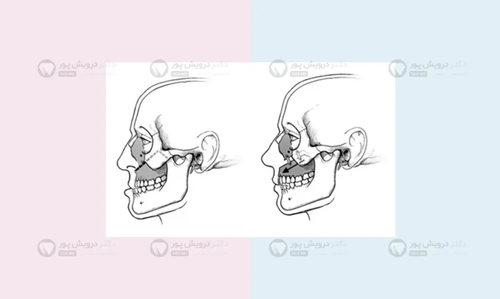 فک بالا و پایین