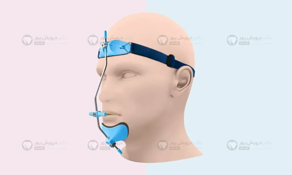 فیس ماسک برای اصلاح بزرگی فک بالا یا پایین