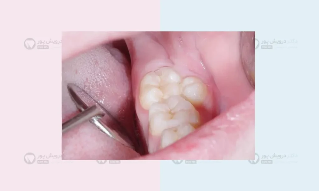 کشیدن دندان اضافی