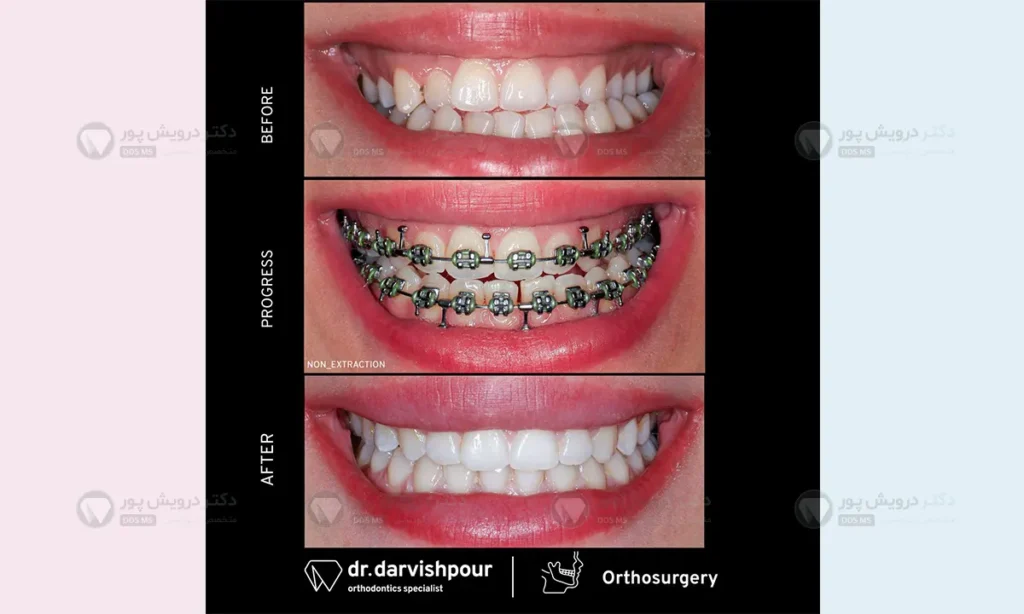 ارتودنسی برای مدیریت دندان غائب