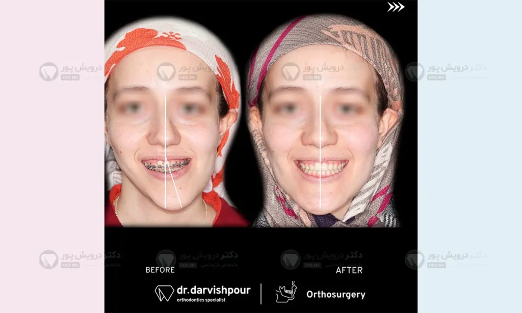 ارتودنسی و جراحی چانه